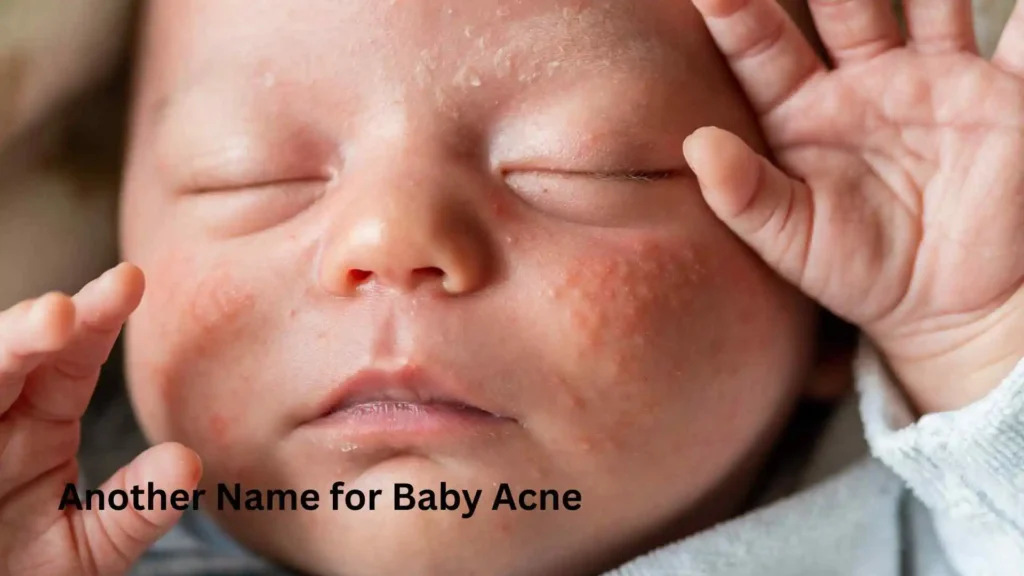 Another Name for Baby Acne
