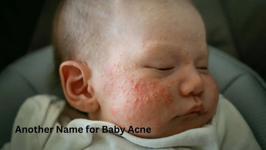 Another Name for Baby Acne