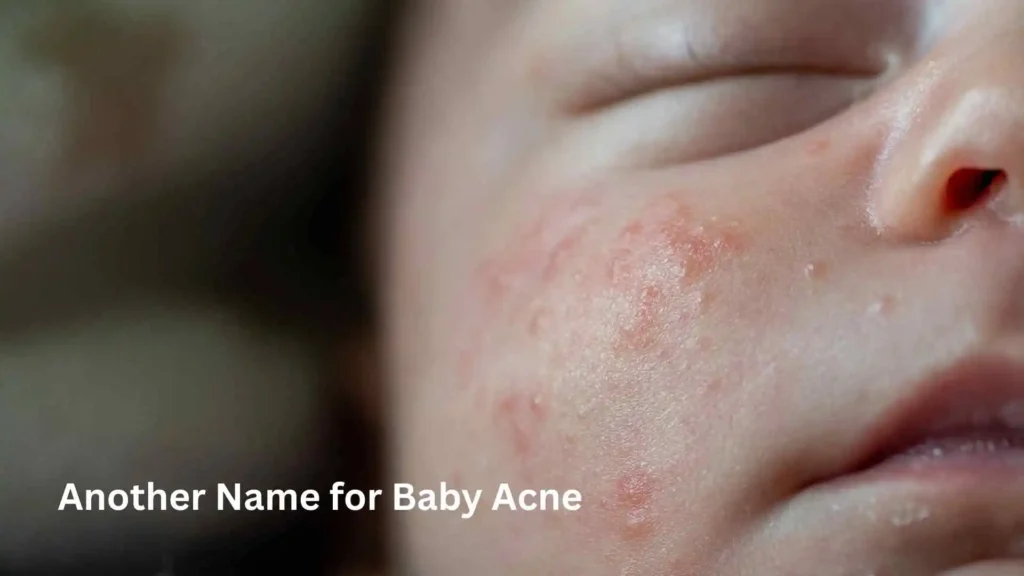 Another Name for Baby Acne