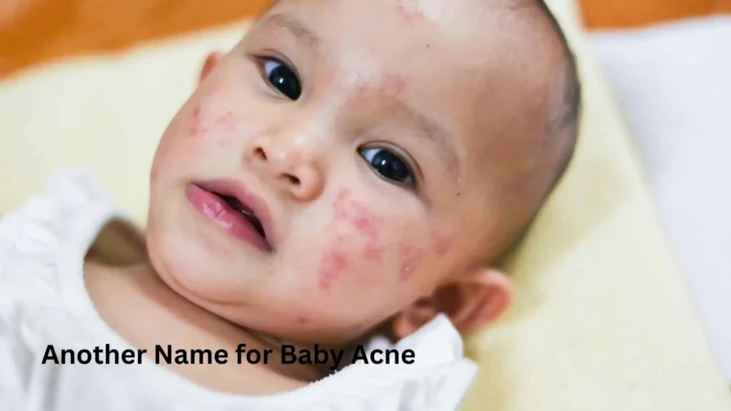 Another Name for Baby Acne